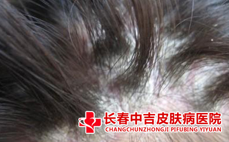 牛皮癣接触会感染吗