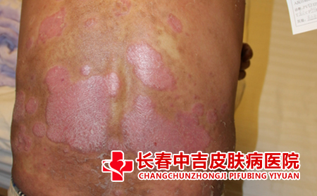 脓包型银屑病的危害