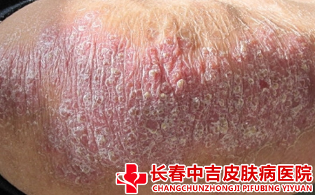 牛皮癣受光照的影响吗