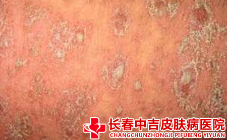 银屑病患者应该怎么进行止痒