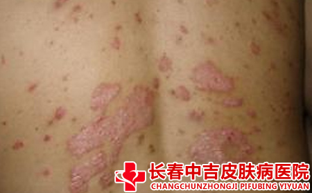 银屑病发生时的症状有什么