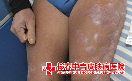 牛皮癣受哪些因素控制