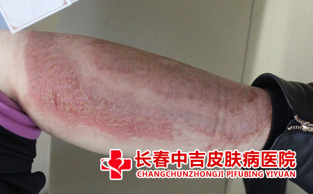 预防牛皮癣的方法