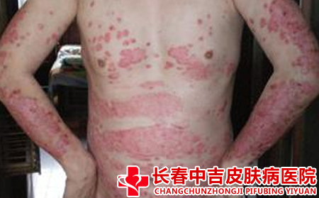 银屑病患者应该怎么注意心理