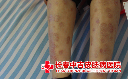牛皮癣食物过敏应对措施