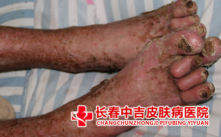 肝火旺盛的牛皮癣护理方法