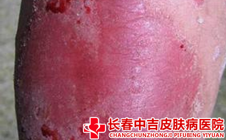 银屑病患者的日常护理方式