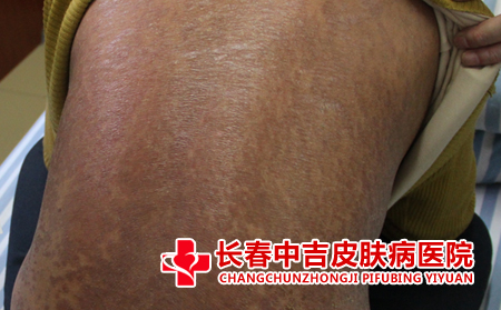 银屑病会传染吗