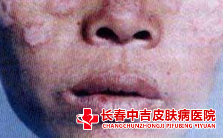牛皮癣蔓延的趋势
