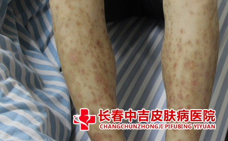 银屑病患者应该怎么注意护理
