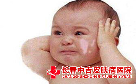 儿童为什么得牛皮癣