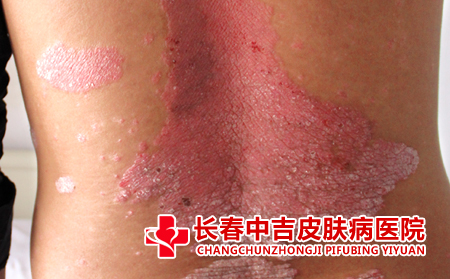 银屑病患者应该怎么进行预防