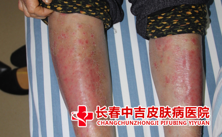 银屑病患者应该怎么注意护理