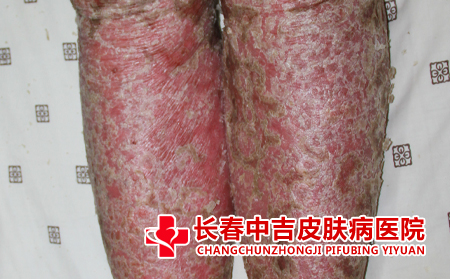 银屑病患者应该怎么提高抵抗力