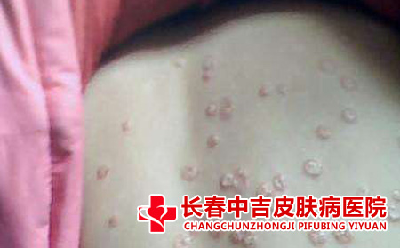  牛皮癣合适喂母乳吗
