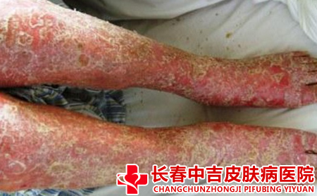 脓包型银屑病的表现特征