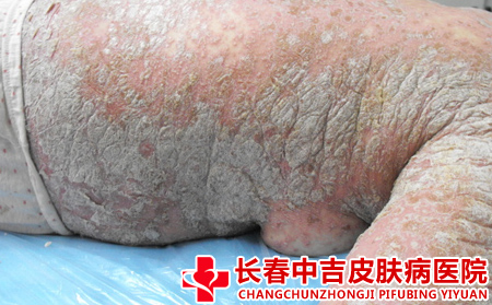  哪些症状表明牛皮癣加重