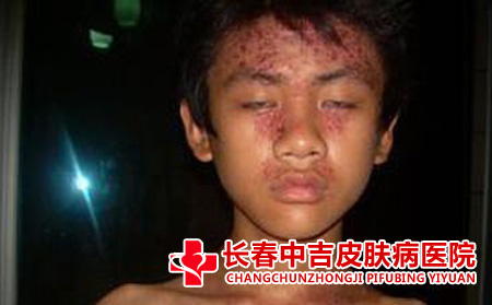 男性牛皮癣遗传常识