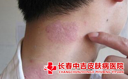  牛皮癣对男孩遗传