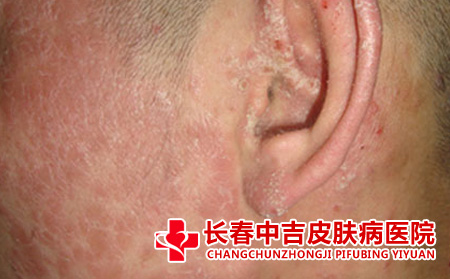   为什么会得银屑病