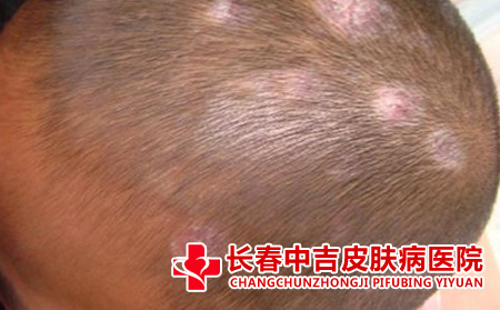 银屑病与癣有什么差异