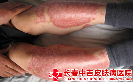  红皮型银屑病判断依据