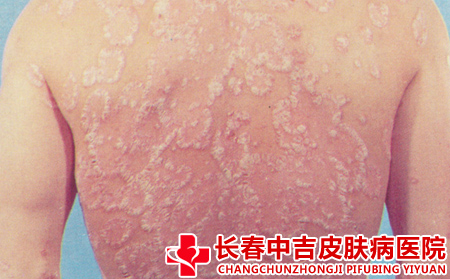  老人牛皮癣缓解的方法