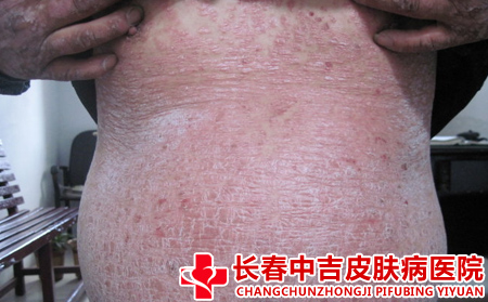 牛皮癣发展经历的不同阶段