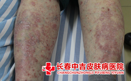  环境因素对牛皮癣的影响