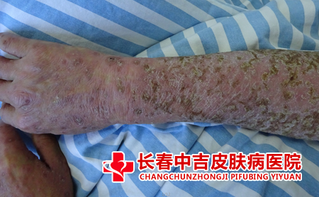 什么是寻常新银屑病