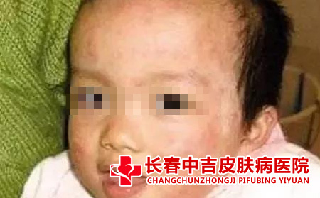  儿童银屑病的表现特征
