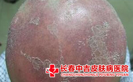 银屑病患者对患者的影响有什么