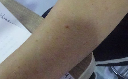 银屑病的护理方法有什么