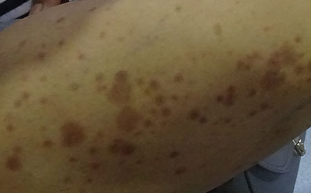 银屑病应该怎么进行预防