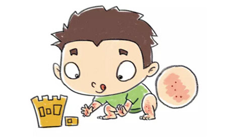 银屑病的护理方法有什么
