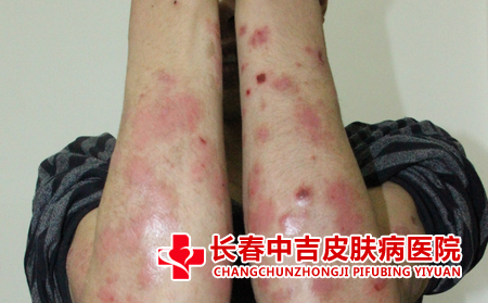 儿童银屑病防止抓挠