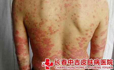 银屑病的症状有什么