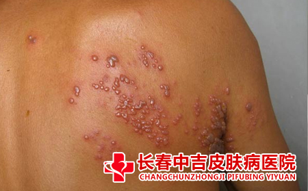 疱疹症状