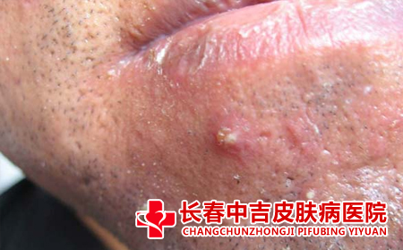毛囊炎症状
