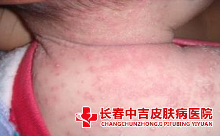 湿疹症状