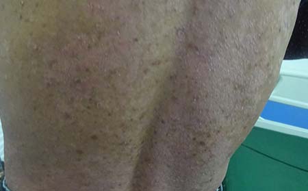 背部银屑病的病因有哪些