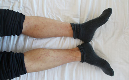 腿部银屑病的治疗方法