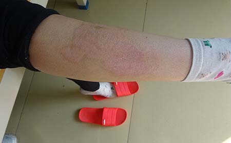 女性银屑病患者的预防方法