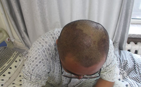 男性银屑病的治疗方法