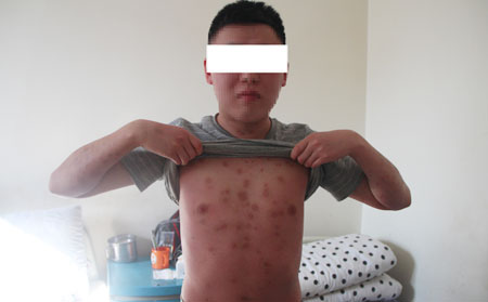 银屑病患者护理方法