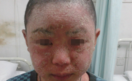 银屑病的诱因有什么