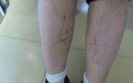 银屑病的危害有什么