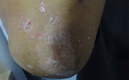 银屑病的危害有什么