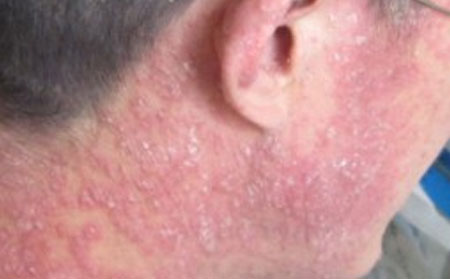 银屑病的治疗方法