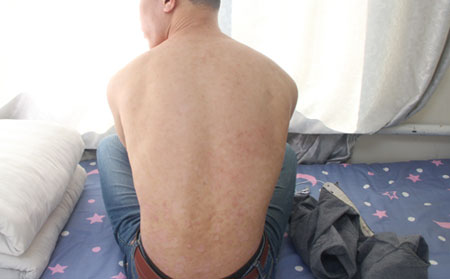 银屑病怎么护理